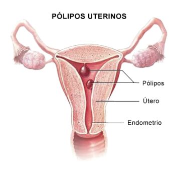 polipos uterinos