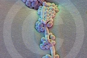 Tratamiento agresivo contra una infección por hongos (candidiasis)