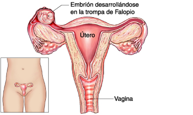 embarazo ectopico