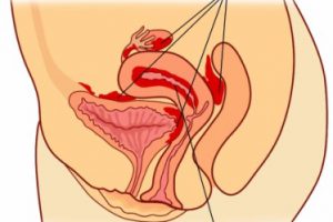 ¿Qué causa la endometriosis?