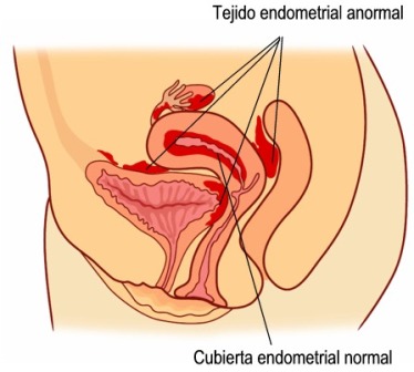 endometriosis