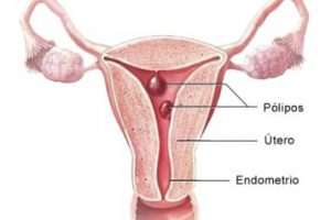 ¿Qué causa los pólipos uterinos?