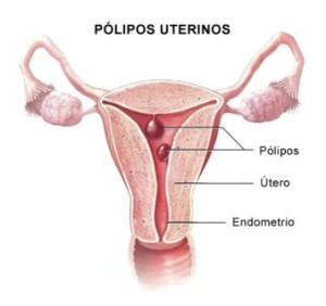 polipos uterinos