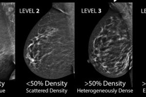 Imágenes de ultrasonido de cáncer de mama