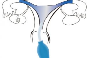 Duchas vaginales: efectos en la salud sexual femenina