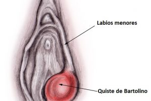 ¿Qué es un quiste/absceso de Bartolino? Síntomas, diagnóstico y tratamiento