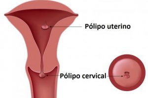 Pólipos cervicales: Causas, Síntomas, Tratamiento y Prevención
